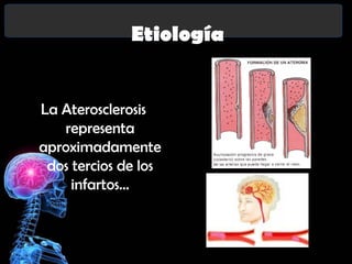 Etiología
La Aterosclerosis
representa
aproximadamente
dos tercios de los
infartos…

 