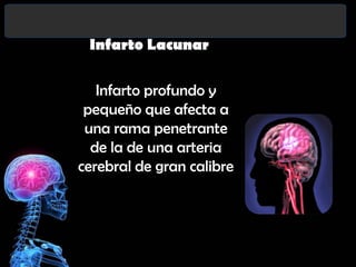 Infarto Lacunar

Infarto profundo y
pequeño que afecta a
una rama penetrante
de la de una arteria
cerebral de gran calibre

 