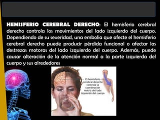 HEMISFERIO CEREBRAL DERECHO: El hemisferio cerebral
derecho controla los movimientos del lado izquierdo del cuerpo.
Dependiendo de su severidad, una embolia que afecte el hemisferio
cerebral derecho puede producir pérdida funcional o afectar las
destrezas motoras del lado izquierdo del cuerpo. Además, puede
causar alteración de la atención normal a la parte izquierda del
cuerpo y sus alrededores

 