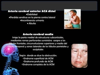 Arteria cerebral anterior ACA distal
•Debilidad
•Perdida sensitiva en la pierna contra lateral
•Incontinencia urinaria
• Abulia

Arteria cerebral media

Irriga la parte medial de estructuras subcorticales,
mediantes ramas perforantes suministra sangre a los
lóbulos frontales, circunvoluciones superiores y media del
lóbulo temporal y zonas laterales de los lóbulos parietales y
occipitales
Según donde se situe la obstrucción:
•Síndrome superficial de ACM
•Síndrome profundo de ACM
•Síndrome completa de la ACM

 