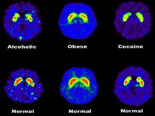                                              PET imaging studies of dopamine receptor levels 