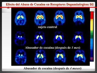 sujeto control Abusador de cocaína (después de  1 mes ) Abusador de cocaína (después de  4 meses ) Efecto del Abuso de Cocaína en Receptores Dopaminérgicos D2 