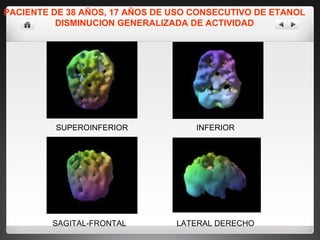 PACIENTE DE 38 AÑOS, 17 AÑOS DE USO CONSECUTIVO DE ETANOL DISMINUCION GENERALIZADA DE ACTIVIDAD SUPEROINFERIOR INFERIOR SAGITAL-FRONTAL LATERAL DERECHO 