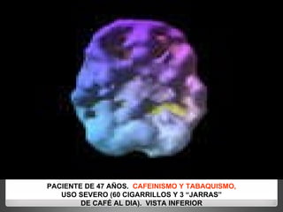 PACIENTE DE 47 AÑOS.  CAFEINISMO Y TABAQUISMO, USO SEVERO (60 CIGARRILLOS Y 3 “JARRAS” DE CAFÉ AL DIA).  VISTA INFERIOR 