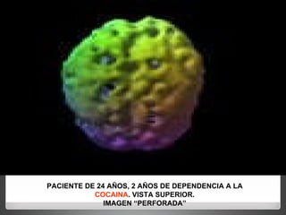 PACIENTE DE 24 AÑOS, 2 AÑOS DE DEPENDENCIA A LA COCAINA . VISTA SUPERIOR. IMAGEN “PERFORADA” 