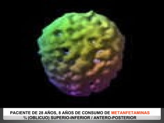 PACIENTE DE 28 AÑOS, 8 AÑOS DE CONSUMO DE  METANFETAMINAS ¾ (OBLICUO) SUPERIO-INFERIOR / ANTERO-POSTERIOR 