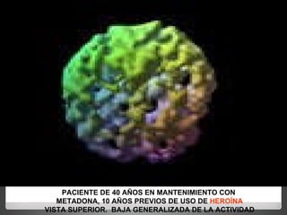 PACIENTE DE 40 AÑOS EN MANTENIMIENTO CON  METADONA, 10 AÑOS PREVIOS DE USO DE  HEROÍNA VISTA SUPERIOR.  BAJA GENERALIZADA DE LA ACTIVIDAD 