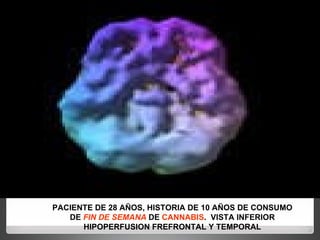PACIENTE DE 28 AÑOS, HISTORIA DE 10 AÑOS DE CONSUMO DE  FIN DE SEMANA  DE  CANNABIS .  VISTA INFERIOR HIPOPERFUSION FREFRONTAL Y TEMPORAL 