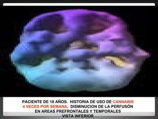 PACIENTE DE 18 AÑOS.  HISTORIA DE USO DE  CANNABIS 4 VECES POR SEMANA .  DISMINUCION DE LA PERFUSÓN EN AREAS PREFRONTALES Y TEMPORALES VISTA INFERIOR 