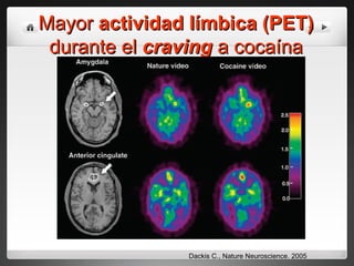 Mayor  actividad límbica   (PET)  durante el  craving  a cocaína Dackis C., Nature Neuroscience. 2005 