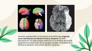 Territorio vascular ACM. A) El territorio de la ACM (rojo) irriga las
caras laterales de los lóbulos frontal y temporal. B) DWI
(secuencia en T2) axial muestra restricción en el territorio de la ACM
izquierda con preservación de los ganglios basales. El territorio de la
ACM es la ubicación más común del ACV isquémico
 