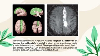 Territorios vasculares ACA. A) La ACA (verde) irriga los 2/3 anteriores de
la superficie del hemisferio medial, el lóbulo frontal anteroinferior medial
y parte de la convexidad cerebral. El cuerpo calloso suele estar irrigado
por ramas de la ACÁ. B) DWI axial muestra restricción de la difusión en el
territorio de la ACÁ izquierda dentro del lóbulo fronta
 