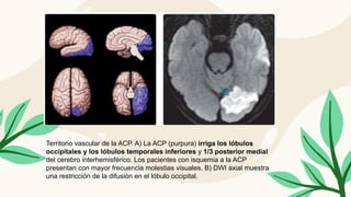Territorio vascular de la ACP. A) La ACP (purpura) irriga los lóbulos
occipitales y los lóbulos temporales inferiores y 1/3 posterior medial
del cerebro interhemisférico. Los pacientes con isquemia a la ACP
presentan con mayor frecuencia molestias visuales. B) DWI axial muestra
una restricción de la difusión en el lóbulo occipital.
 