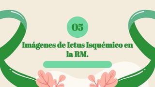 Imágenes de Ictus Isquémico en
la RM.
05
 