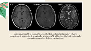 En las secuencias T1 se observa hipodensidad de la corteza frontoinsular y refuerzo
persistente de las arterias de la región. En la secuencia T2 la hiperintesidad en la corteza y la
sustancia blanca subcortical representa edema.
 
