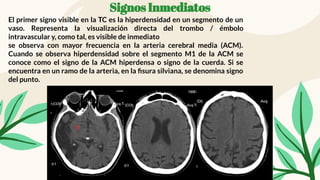 Signos Inmediatos
El primer signo visible en la TC es la hiperdensidad en un segmento de un
vaso. Representa la visualización directa del trombo / émbolo
intravascular y, como tal, es visible de inmediato
se observa con mayor frecuencia en la arteria cerebral media (ACM).
Cuando se observa hiperdensidad sobre el segmento M1 de la ACM se
conoce como el signo de la ACM hiperdensa o signo de la cuerda. Si se
encuentra en un ramo de la arteria, en la ﬁsura silviana, se denomina signo
del punto.
 