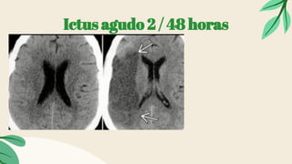 Ictus agudo 2 / 48 horas
 