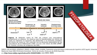 ZARCO, LUIS ALFONSO, GONZÁLEZ, FREDDY, CORAL CASAS, JULIANA, Tratamiento actual del ataque cerebrovascular isquémico (ACV) agudo. Universitas
Medica [en linea] 2008, 49 (Octubre-Diciembre) : [Fecha de consulta: 24 de junio de 2019] Disponible
en:<http://www.redalyc.org/articulo.oa?id=231018741004> ISSN 0041-9095
 