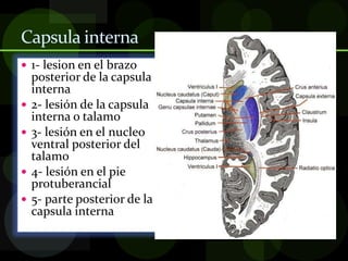 Capsula interna
 1- lesion en el brazo
posterior de la capsula
interna
 2- lesión de la capsula
interna o talamo
 3- lesión en el nucleo
ventral posterior del
talamo
 4- lesión en el pie
protuberancial
 5- parte posterior de la
capsula interna
 