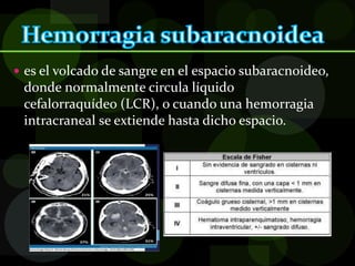 es el volcado de sangre en el espacio subaracnoideo,
donde normalmente circula líquido
cefalorraquídeo (LCR), o cuando una hemorragia
intracraneal se extiende hasta dicho espacio.
 