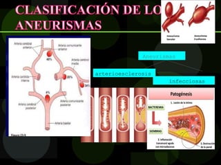 Aneurismas
infecciosas
arterioesclerosis
 