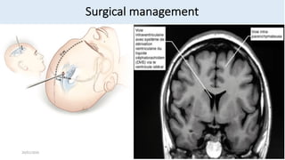 External Ventricular Drainage How to do it.pdf