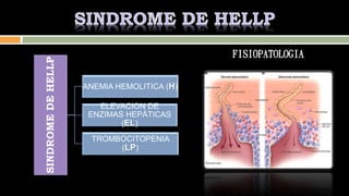 SINDROMEDEHELLP
ANEMIA HEMOLITICA (H)
ELEVACION DE
ENZIMAS HEPÁTICAS
(EL)
TROMBOCITOPENIA
(LP)
FISIOPATOLOGIA
 