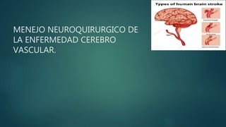 MENEJO NEUROQUIRURGICO DE
LA ENFERMEDAD CEREBRO
VASCULAR.
 