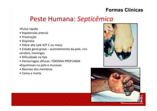 Peste Humana: Septicêmica
•Pulso rápido
• Hipotensão arterial
• Prostração
• Dispinéia
• Febre alta (até 42º C ou mais)
• Estado geral grave – acometimento da pele, rins
cérebro, meninges
• Dificuldade na fala
• Hemorragias difusas: TOXEMIA PROFUNDA
•Equimoses na pele e mucosas
• Necrose dos membros
• Coma e morte
Formas Clínicas
 