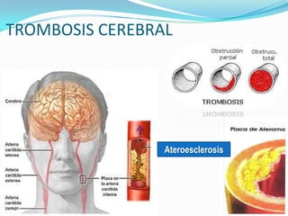 TROMBOSIS CEREBRAL




                 Ateroesclerosis
 