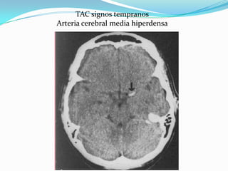 TAC signos tempranos
Arteria cerebral media hiperdensa
 