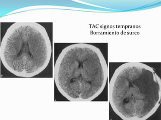 TAC signos tempranos
Borramiento de surco
 