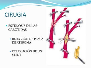 CIRUGIA
 ESTENOSIS DE LAS
 CARÓTIDAS

   RESECCIÓN DE PLACA
   DE ATEROMA

   COLOCACIÓN DE UN
   STENT
 