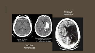 TAC EVC
hemorrágico
TAC EVC
isquémico
 