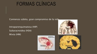 FORMAS CLÍNICAS
Comienzo súbito, gran compromiso de la vida.
Intraparenquimatosa (HIP)
Subaracnoidea (HSA)
Mixta (HM)
 