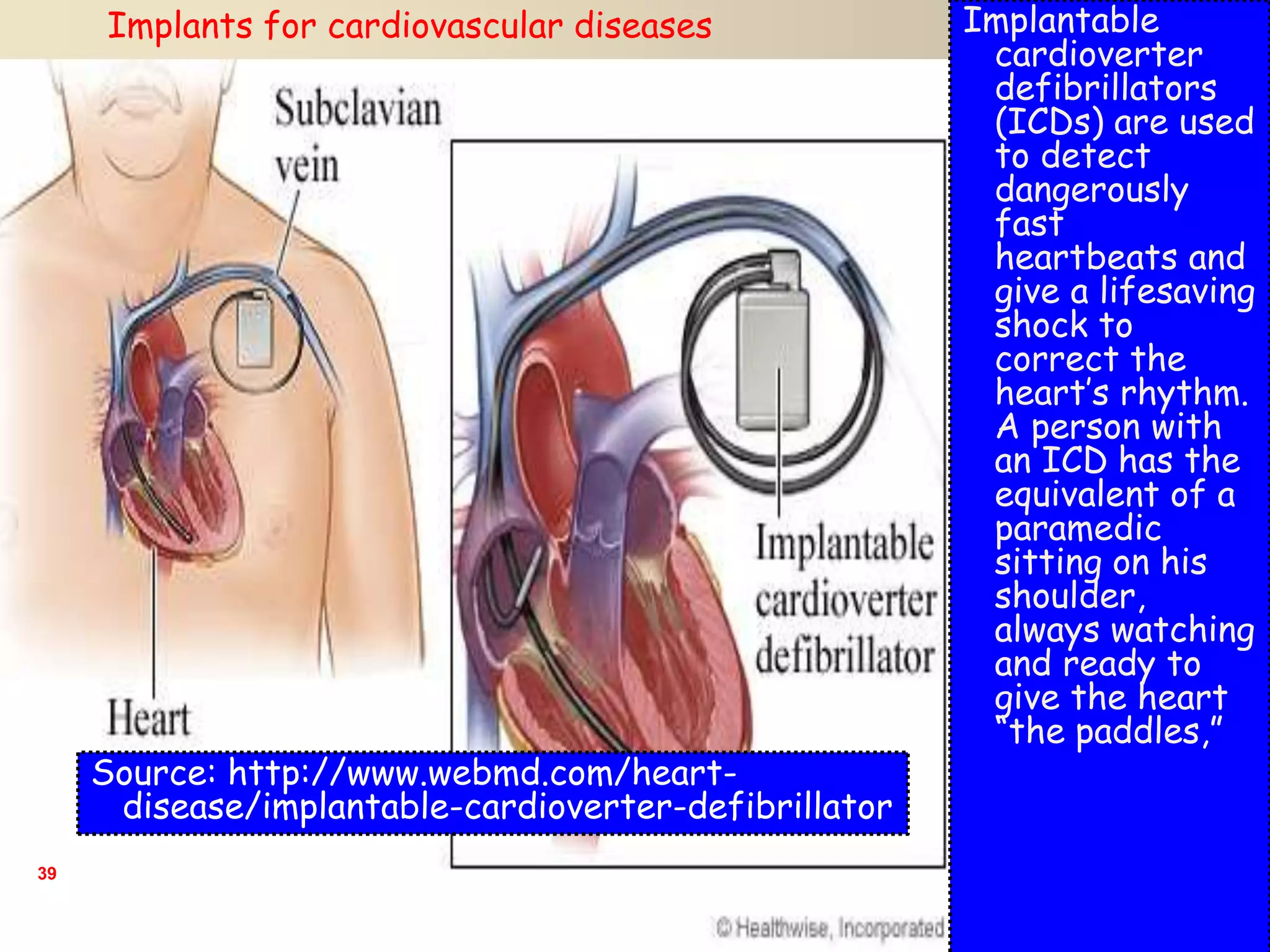 39
Implantable
cardioverter
defibrillators
(ICDs) are used
to detect
dangerously
fast
heartbeats and
give a lifesaving
shock to
correct the
heart’s rhythm.
A person with
an ICD has the
equivalent of a
paramedic
sitting on his
shoulder,
always watching
and ready to
give the heart
“the paddles,”
Implants for cardiovascular diseases
Source: http://www.webmd.com/heart-
disease/implantable-cardioverter-defibrillator
 