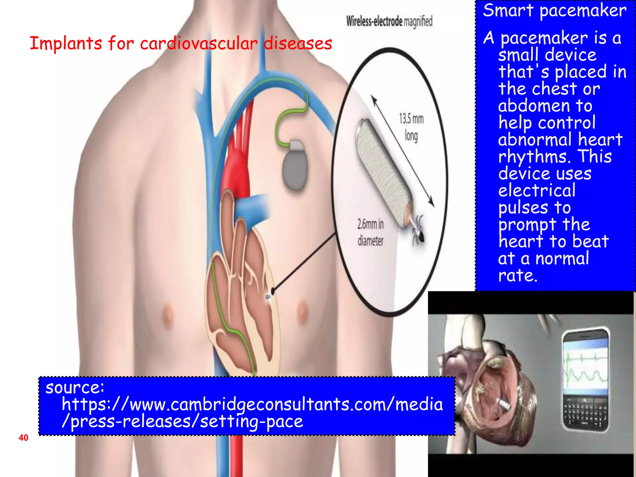40
Smart pacemaker
A pacemaker is a
small device
that's placed in
the chest or
abdomen to
help control
abnormal heart
rhythms. This
device uses
electrical
pulses to
prompt the
heart to beat
at a normal
rate.
Implants for cardiovascular diseases
source:
https://www.cambridgeconsultants.com/media
/press-releases/setting-pace
 
