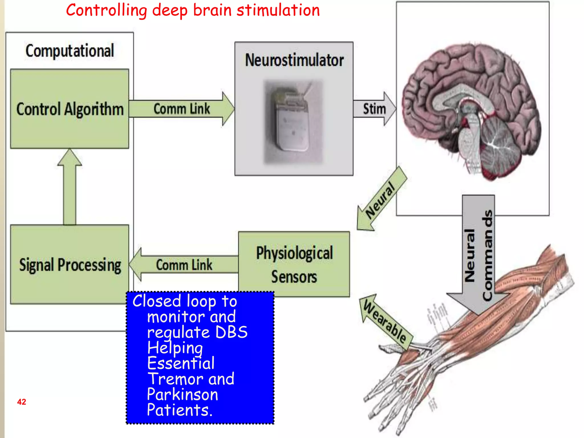 42
Closed loop to
monitor and
regulate DBS
Helping
Essential
Tremor and
Parkinson
Patients.
Controlling deep brain stimulation
 