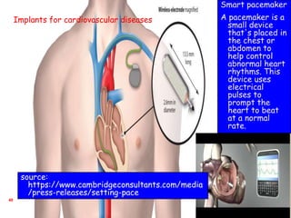 40
Smart pacemaker
A pacemaker is a
small device
that's placed in
the chest or
abdomen to
help control
abnormal heart
rhythms. This
device uses
electrical
pulses to
prompt the
heart to beat
at a normal
rate.
Implants for cardiovascular diseases
source:
https://www.cambridgeconsultants.com/media
/press-releases/setting-pace
 
