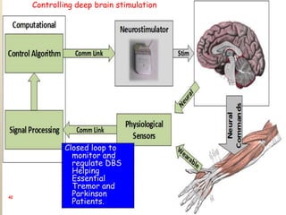 42
Closed loop to
monitor and
regulate DBS
Helping
Essential
Tremor and
Parkinson
Patients.
Controlling deep brain stimulation
 