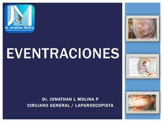 EVENTRACIONES
Dr. JONATHAN L MOLINA P
CIRUJANO GENERAL / LAPAROSCOPISTA
 