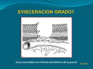 EVISCERACION GRADO1
Asas contenidas en el fondo del defecto de la pared
Dr. R.F.
 
