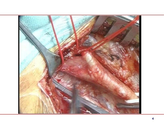 carotid endarterectomy anesthesia