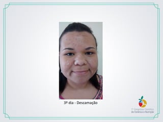 3º dia - Descamação
 