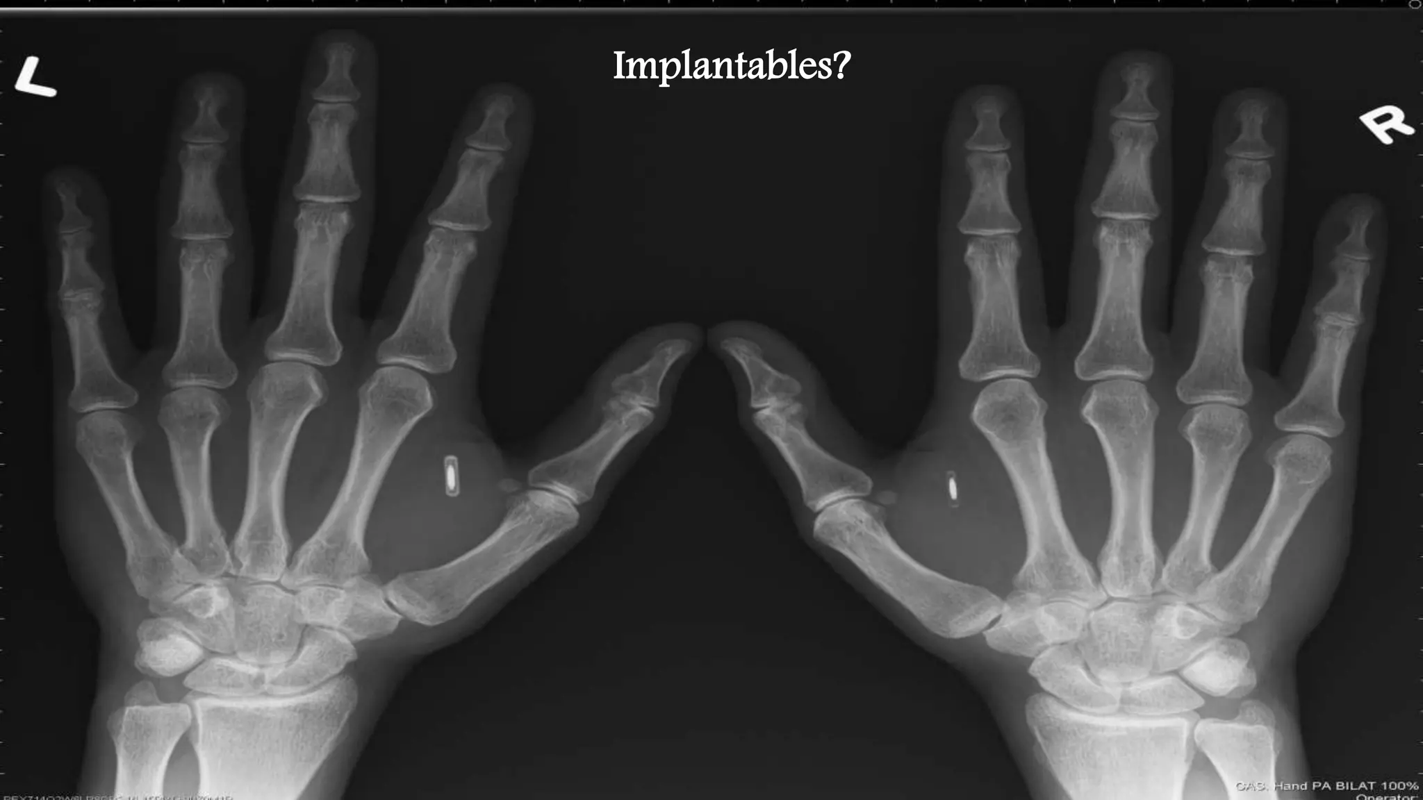 Implantables? 
 