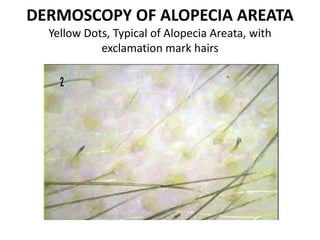 everything-you-need-to-know-about-alopecia-areata-pdf