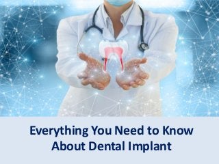 Everything You Need to Know
About Dental Implant
 