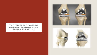 TWO DIFFERENT TYPES OF
KNEE REPLACEMENT EXIST:
TOTAL AND PARTIAL.
 