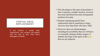 PARTIAL KNEE
REPLACEMENT
If you receive a partial knee
replacement, your surgeon will replace
only the part of your knee that’s
damaged or arthritic.
The advantage to this type of procedure is
that it requires a smaller incision, involves
less bone and blood loss and consequently
produces less pain.
Patients undergoing partial knee
replacement tend to experience a faster
recovery time than those who have TKR.
However, there are disadvantages,
including the possibility that you will have
to eventually undergo further surgery if
arthritis develops in the parts of the knee
that are not replaced.
 