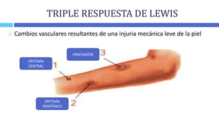 TRIPLE RESPUESTA DE LEWIS
 Cambios vasculares resultantes de una injuria mecánica leve de la piel
ERITEMA
CENTRAL
ERITEMA...